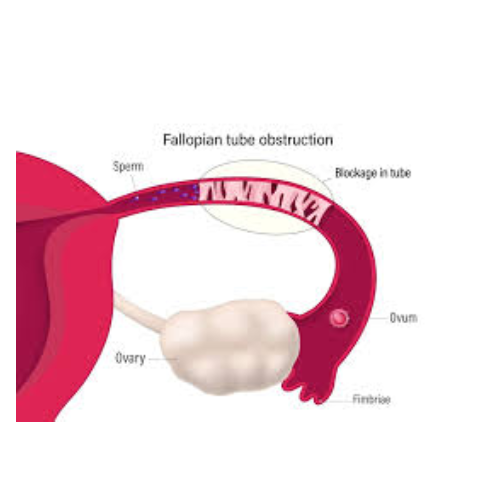 Fallopian tube blocks(other problems)