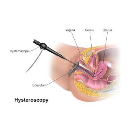 Hysteroscopy