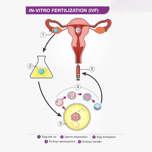 In-vitro fertilization (IVF)
