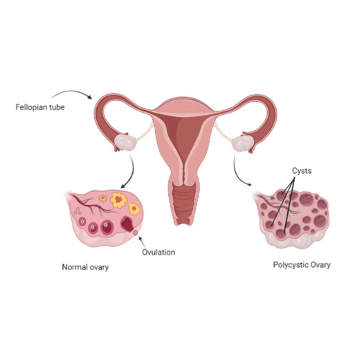 Polycystic Ovarian Syndrome(Disease)