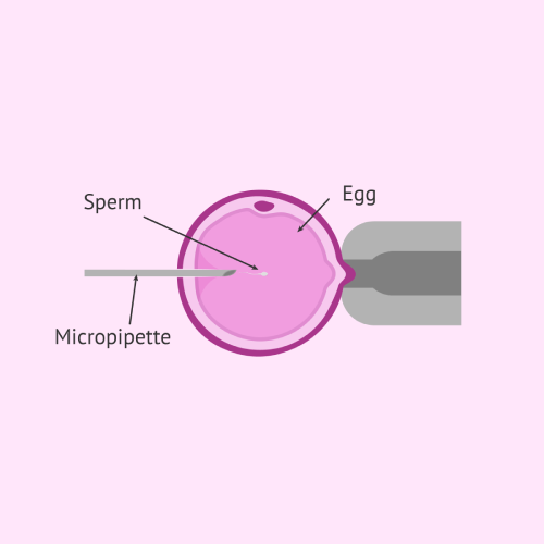 Intra-Cytoplasmic Sperm Injection (ICSI)