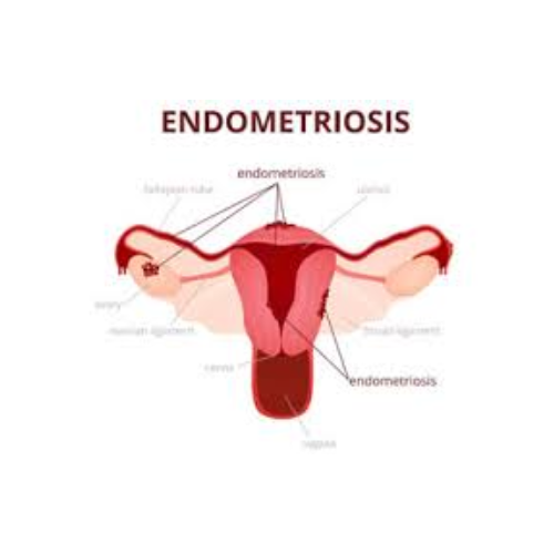 Endometriosis