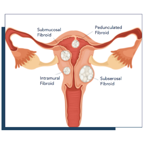 Fibroids