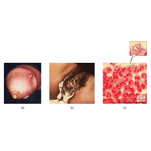Female and Male Genital Infections