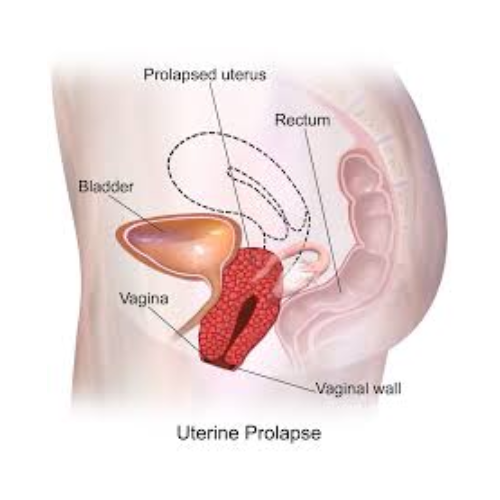 Uterine and Vaginal Problems