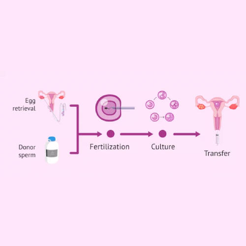 Donor Egg/Sperm IVF/ICSI cycles